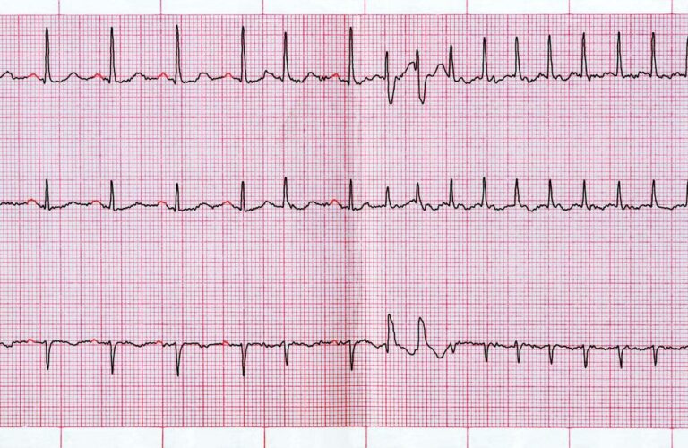 Palpitations cardiaques : astuce pour faire baisser naturellement son rythme cardiaque