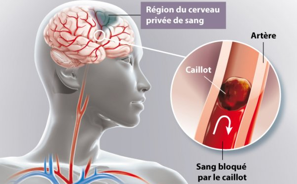 Quels sont les signes d’alerte d’un AVC et comment réagir ?