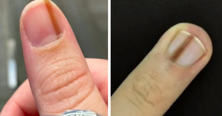 Pourquoi vous devez consulter un médecin si vous voyez des stries sur votre ongle