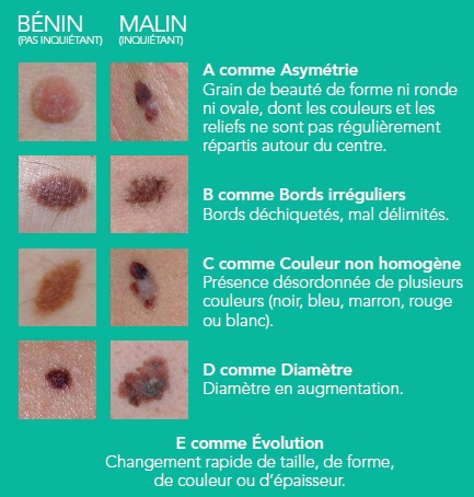 La règle de l’ABCDE pour distinguer une grain de beauté bénin d’un mélanome