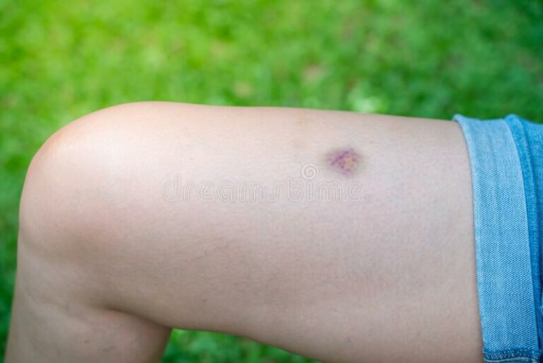 Pourquoi vous avez des bleus sans raison apparente : quand votre corps tente de vous alerter