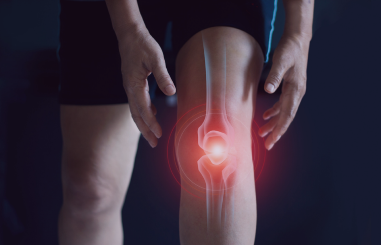 Arthrose du genou : 5 exercices essentiels pour soulager la douleur