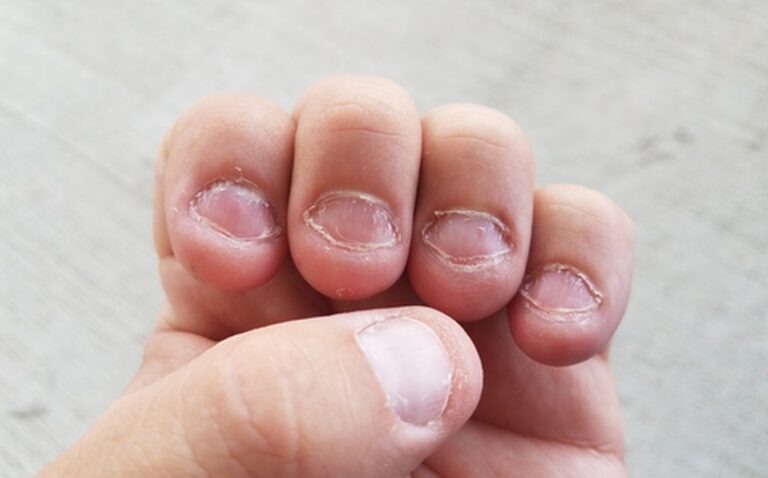 Comment arrêter de se ronger les ongles ? 7 Causes de l’onychophagie