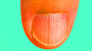 Ongles striés : ce qu’ils révèlent sur votre santé